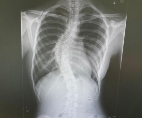 Erin's x-ray before surgery